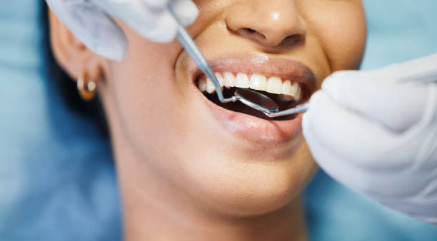Best Chipped Tooth Repair Near Me  in Montpelier, OH